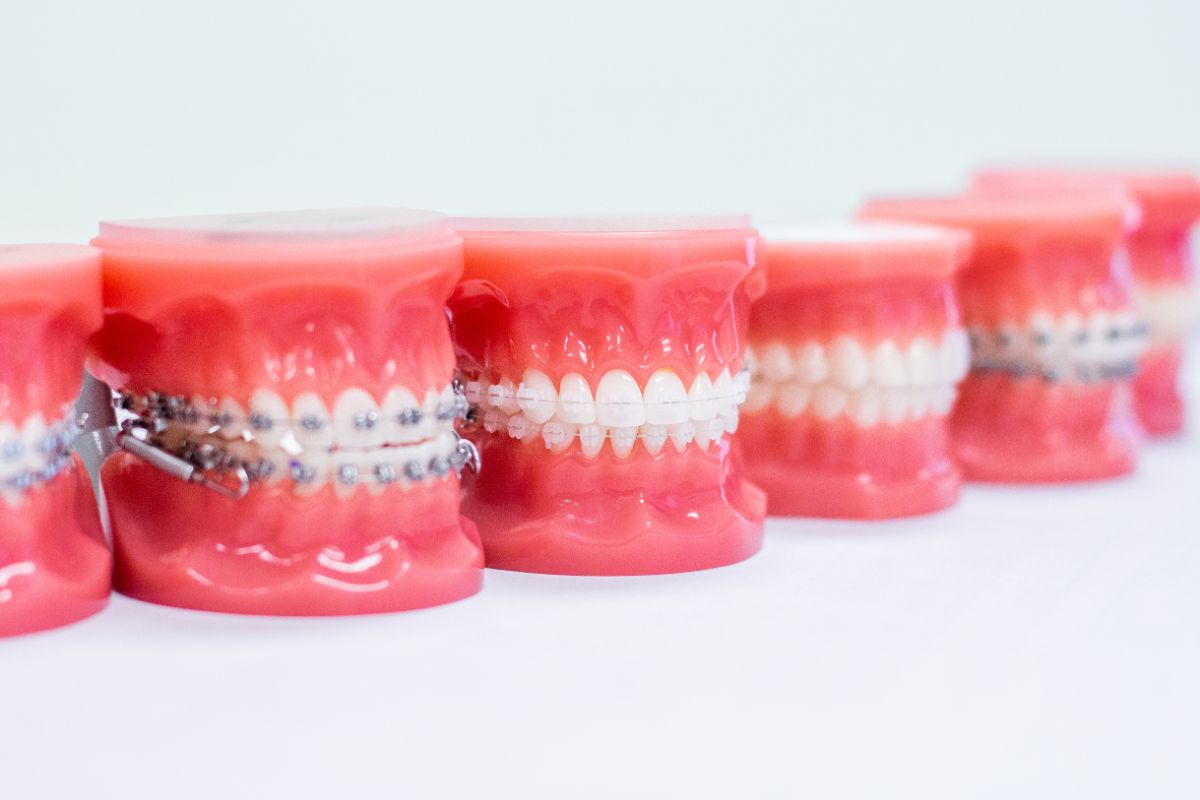 The Different Types of Braces